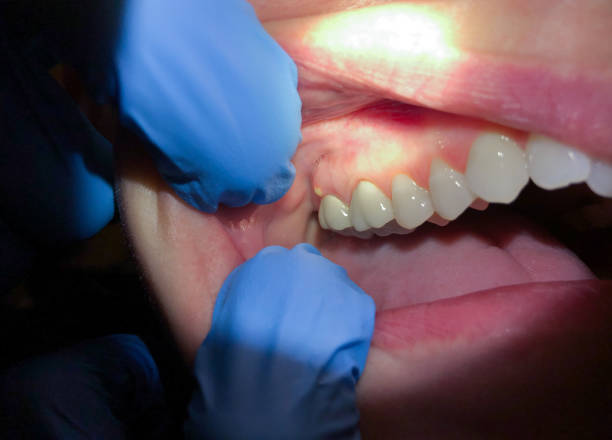 Best Emergency Care for Gum Disease in Charlotte, TN